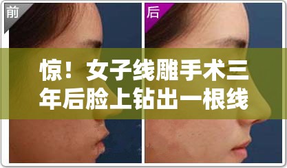 惊！女子线雕手术三年后脸上钻出一根线，美容变“毁容”？真相让人不寒而栗！